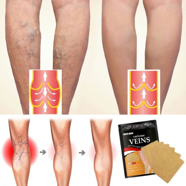 Varicose™ Parches Herbales Para Piernas Cansadas (2x1)