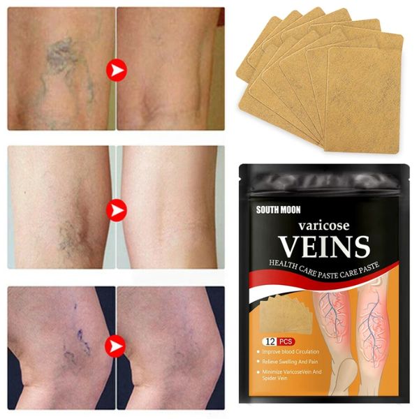 Varicose™ Parches Herbales Para Piernas Cansadas (2x1)